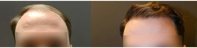 2,200 Hair Graft Hair Transplant Case Study &ndash; Norwood Class 5 &ndash; before and after