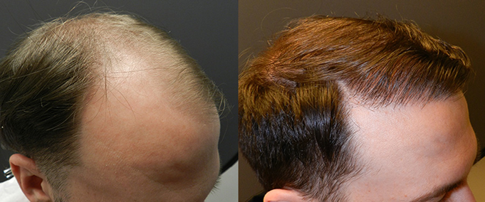 2,200 Hair Graft Hair Transplant Case Study &ndash; Norwood Class 5 &ndash; before and after