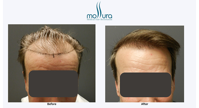 2,320 Hair Grafts Transplanted to Restore Hairline &ndash; before and after