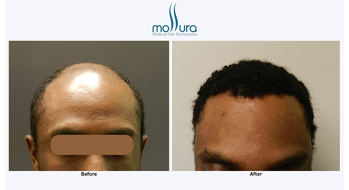 African American Hair Transplant Results &ndash; before and after