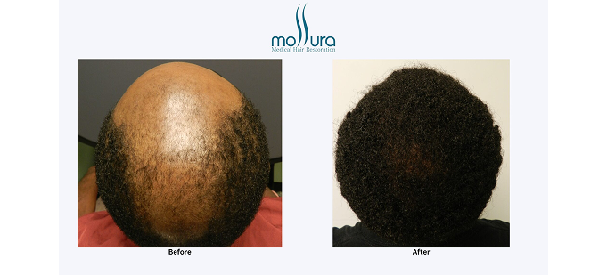 African American Hair Transplant Results &ndash; before and after
