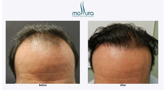 Frontal Hairline Restoration with FUE Hair Transplant + PRP &ndash; before and after