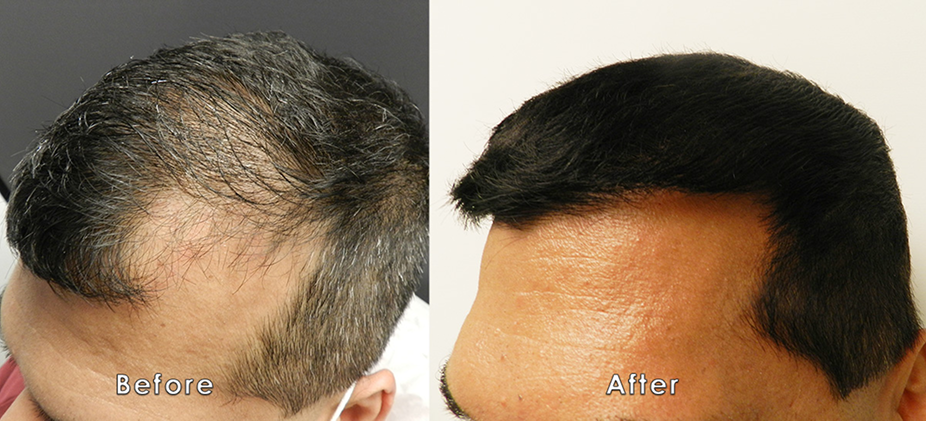FUE Hair Transplant To Fill Temporal Hairline &ndash; before and after