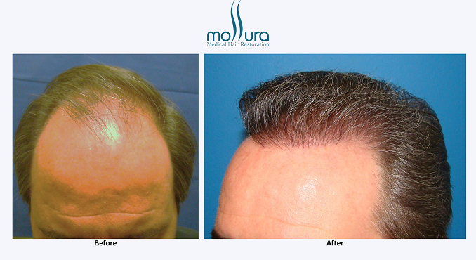Hair Restoration Journey &ndash; before and after