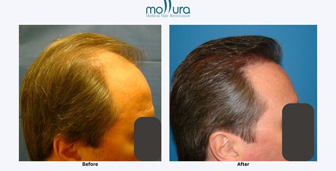 Hair Restoration Journey &ndash; before and after