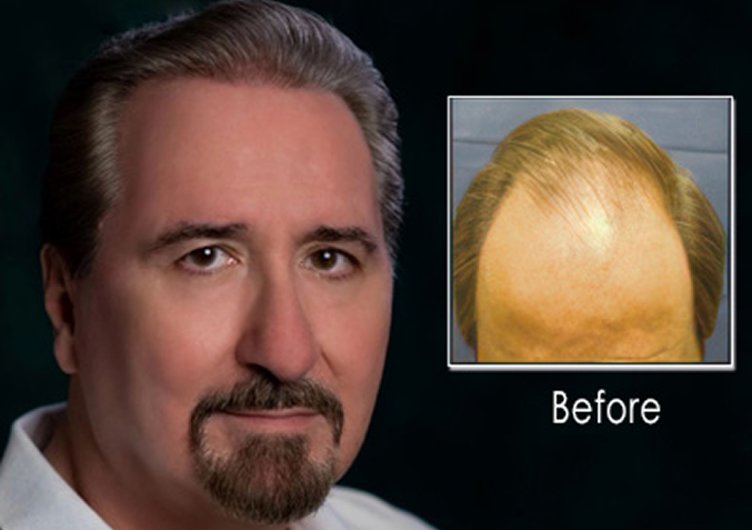 Hair Restoration Journey &ndash; before and after