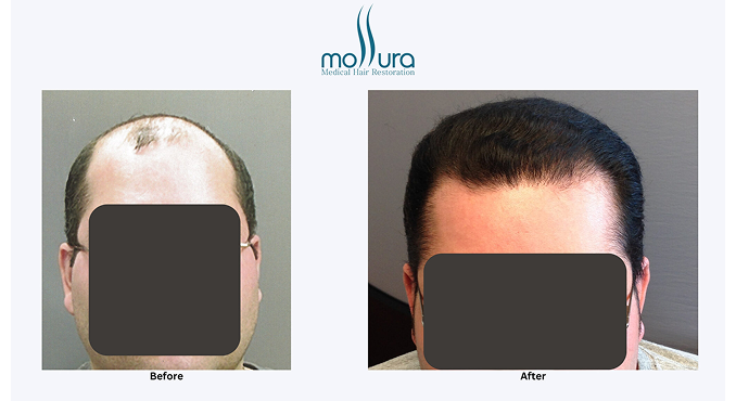 Norwood Class 5 Hair Transplant with 3,900 Hair Grafts &ndash; before and after