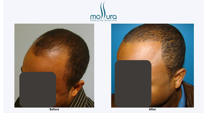 Short Hair Hair Transplant with FUE Procedure &ndash; before and after
