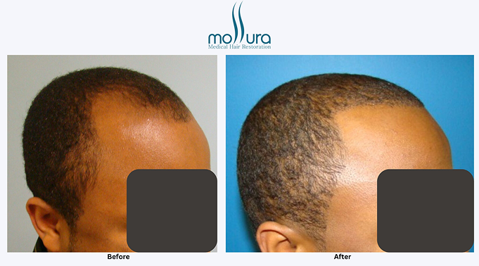 Short Hair Hair Transplant with FUE Procedure &ndash; before and after