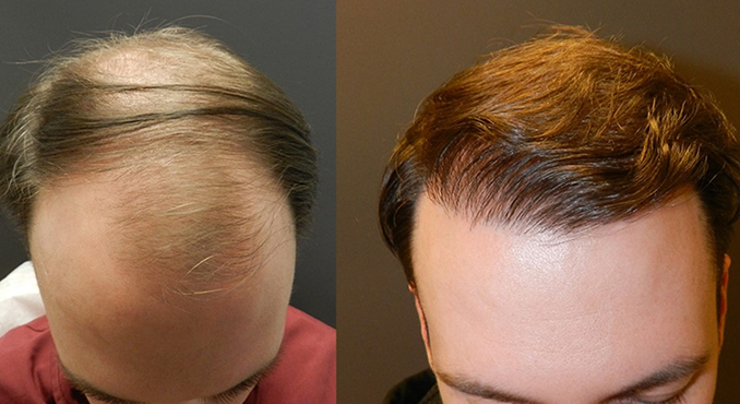 Before and after photographs of a Mollura Medical patient, 2,200 grafts