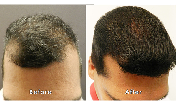 Before and after photographs of a Mollura Medical patient, 2,179 grafts across two sessions