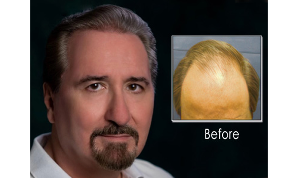 Before and after photographs of a Mollura Medical patient, 13 years, two procedures