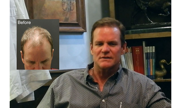 Before and after photographs of a Mollura Medical patient, 2,855 grafts
