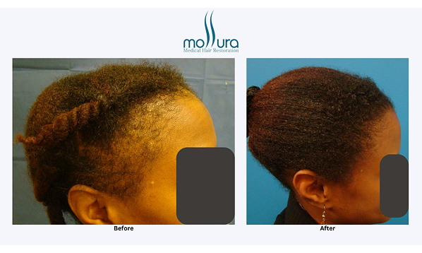 Before and after photographs of a Mollura Medical patient, 2,032 grafts
