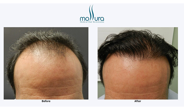 Frontal Hairline Restoration with FUE Hair Transplant + PRP