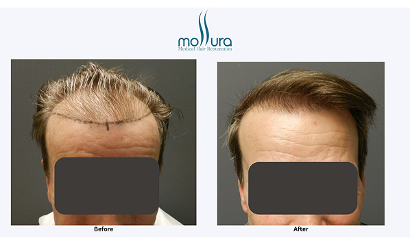 Before and after photographs of a Mollura Medical patient, 2,320 grafts