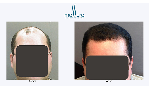 Before and after photographs of a Mollura Medical patient, 3,900 grafts, single session