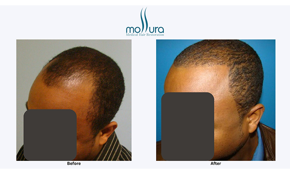 Before and after photographs of a Mollura Medical patient, 1,212 grafts