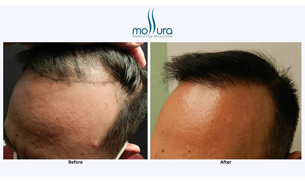 Before and after photographs of a Mollura Medical patient, 3,506 grafts across two sessions