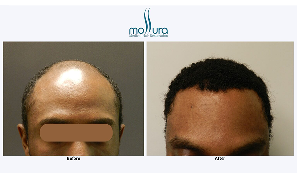Before and after photographs of a Mollura Medical patient, 5,217 grafts across two procedures
