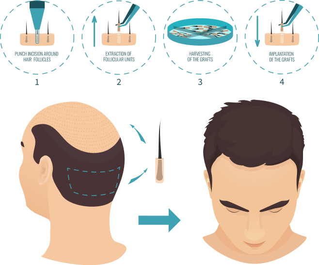 Diagram of the FUE hair transplant process: punch incision, extraction of follicular units, harvesting of the grafts, and implantation of the grafts