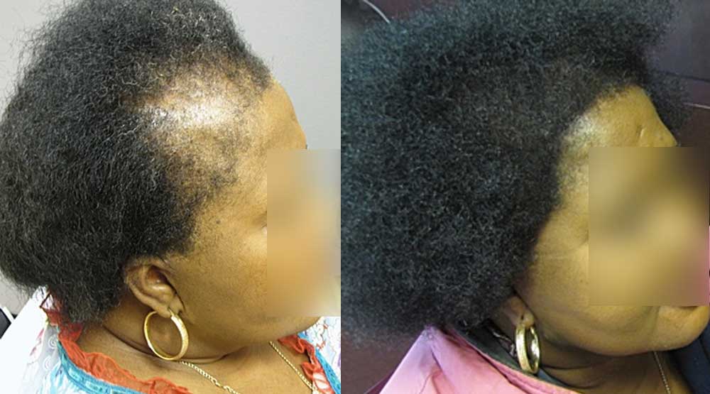 AlopeciaAreataSide2