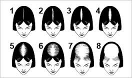 Progressive Hair Loss Classifications - Mollura Hair Restoration - Long  Island