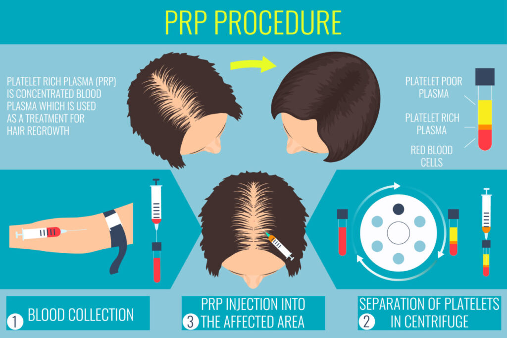PRP_Hair_Loss_Therapy
