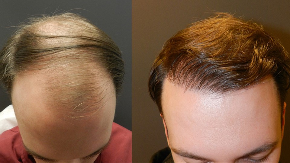 Before and 8 months after FUT hgair transplant