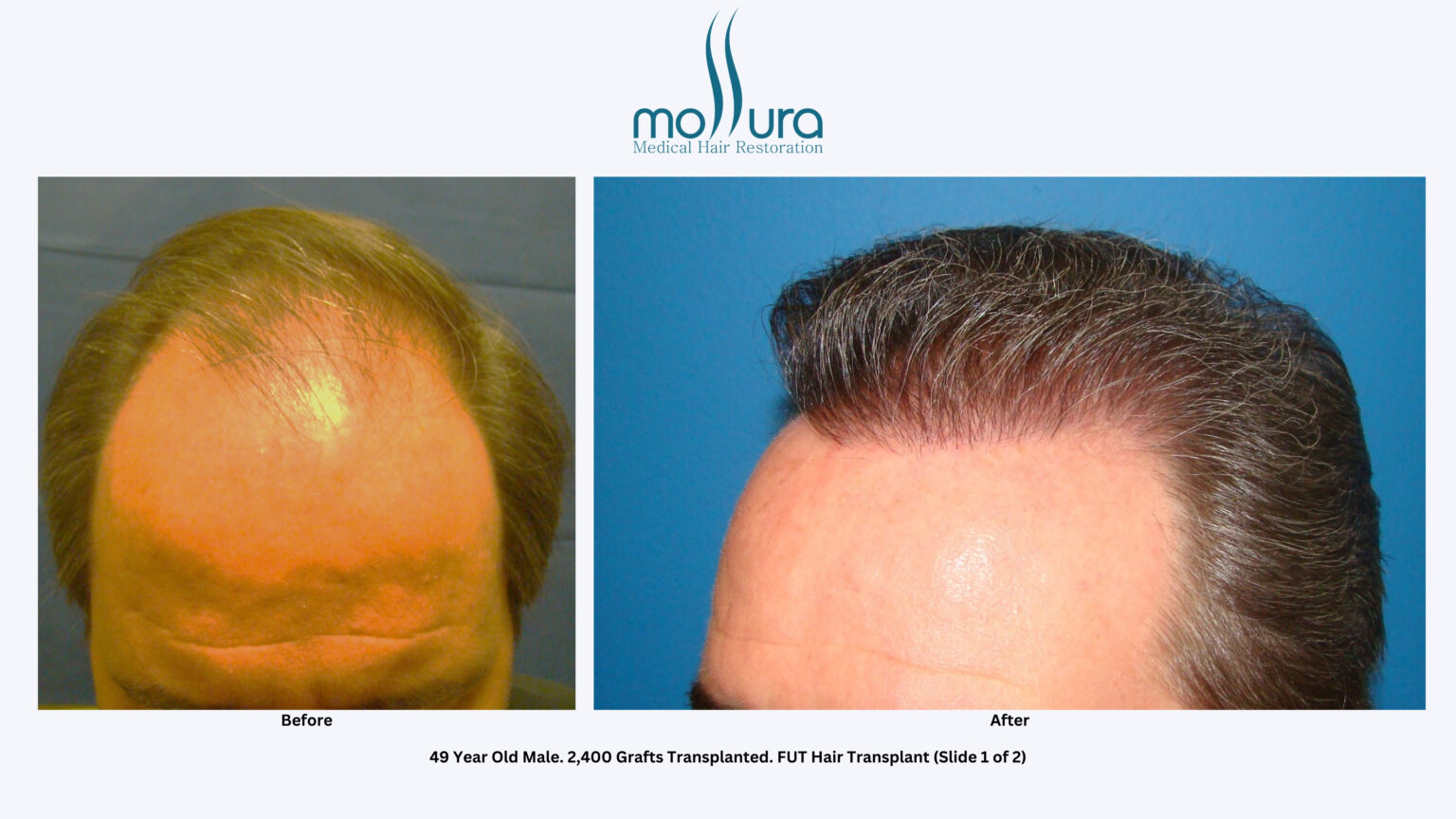 Male Hair Transplant Before And After Photos Mollura Hair Restoration Long Island 4814