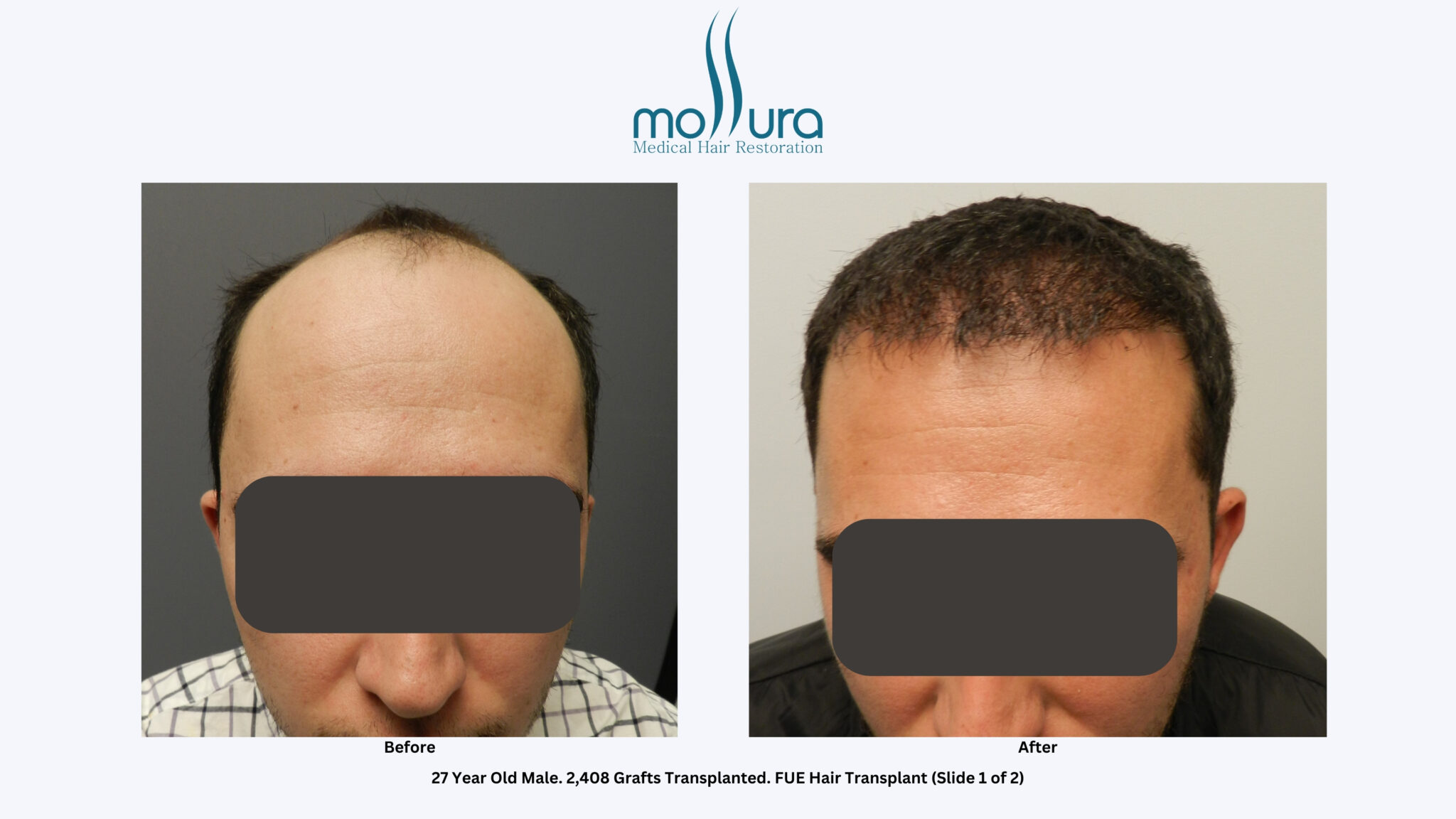 Male Hair Transplant Before And After Photos Mollura Hair Restoration Long Island 7498