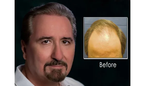 Before and after photographs of a Mollura Medical patient, 13 years, two procedures