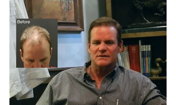 Before and after photographs of a Mollura Medical patient, 2,855 grafts