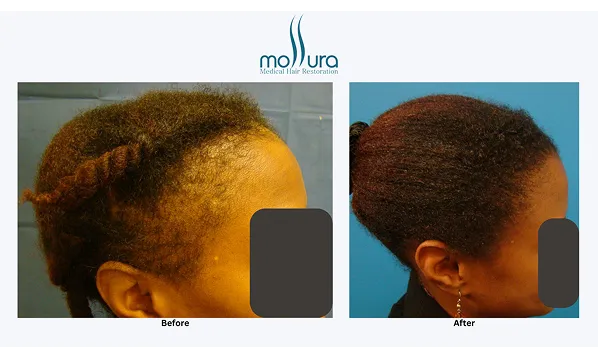 Before and after photographs of a Mollura Medical patient, 2,032 grafts