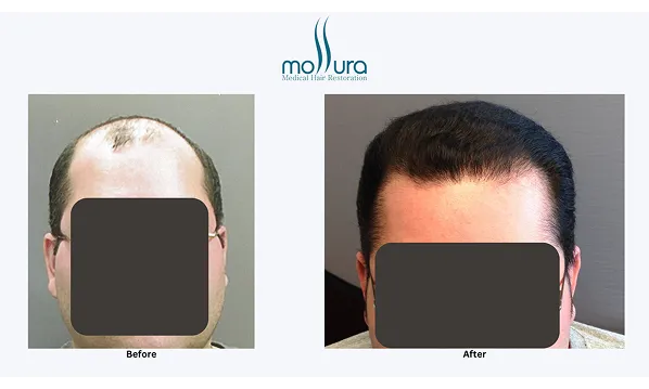 Before and after photographs of a Mollura Medical patient, 3,900 grafts, single session