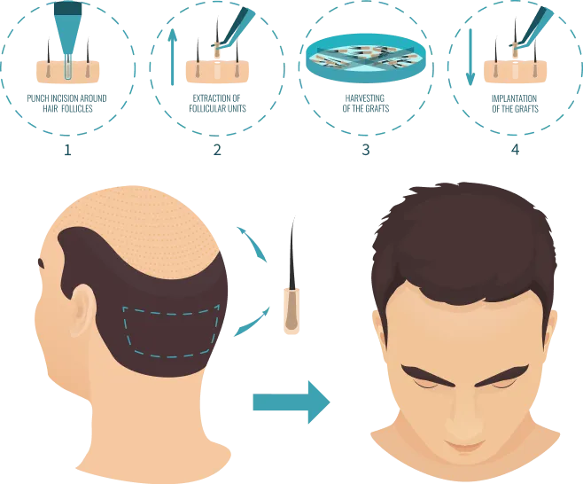 Diagram of the FUE hair transplant process: punch incision, extraction of follicular units, harvesting of the grafts, and implantation of the grafts