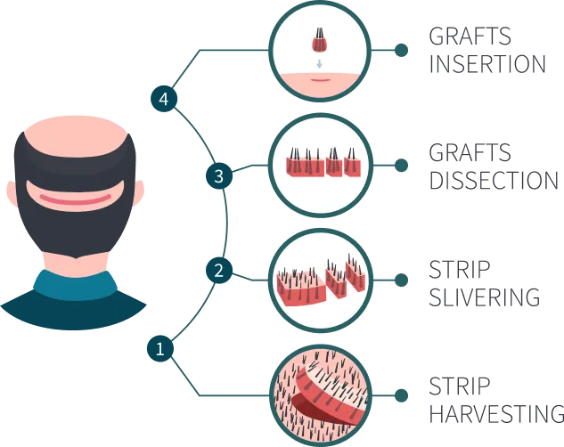 Diagram of the FUT hair transplant process: strip harvesting, strip slivering, grafts dissection, and grafts insertion