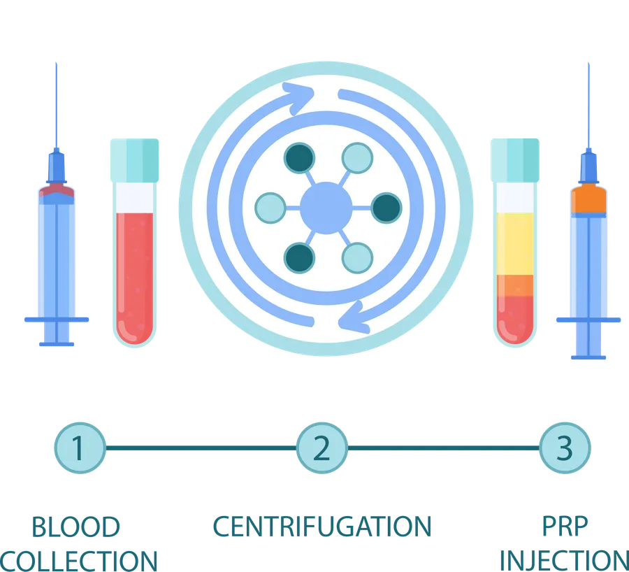 Diagram of the PRP process: blood collection, centrifugation, and PRP injection