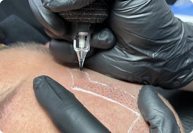 Close-up of a scalp micropigmentation needle creating a hairline guideline