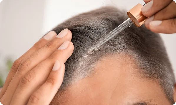 Applying topical hair loss serum with a dropper to a man's hairline